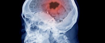 研究新突破：对最致命的脑癌可进行更好的治疗