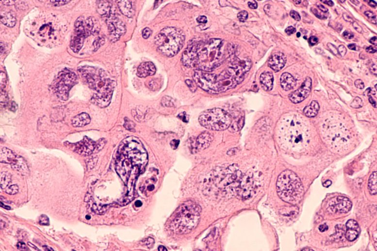 FDA批准新的影像学药物以帮助识别卵巢癌病变