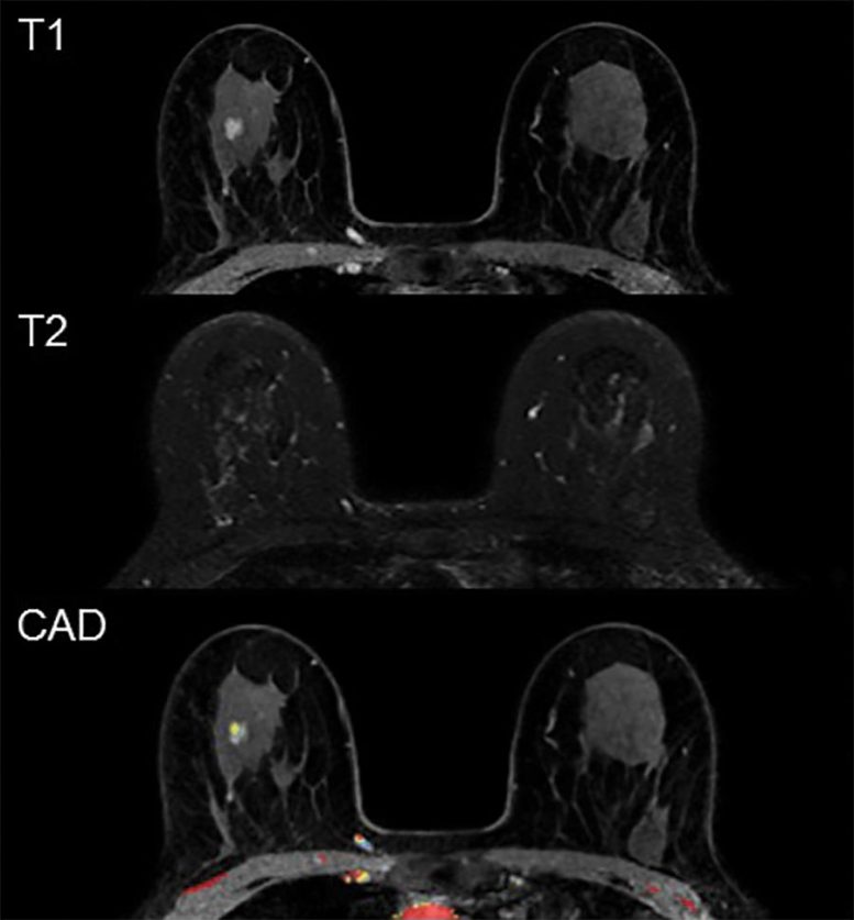 假阳性 MRI 乳腺癌筛查